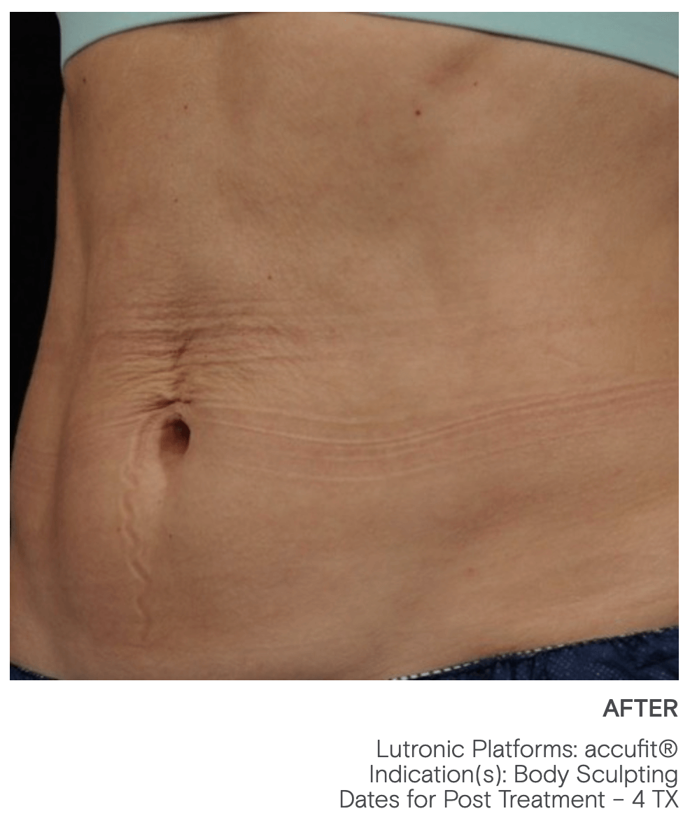 Lutronic Accufit After