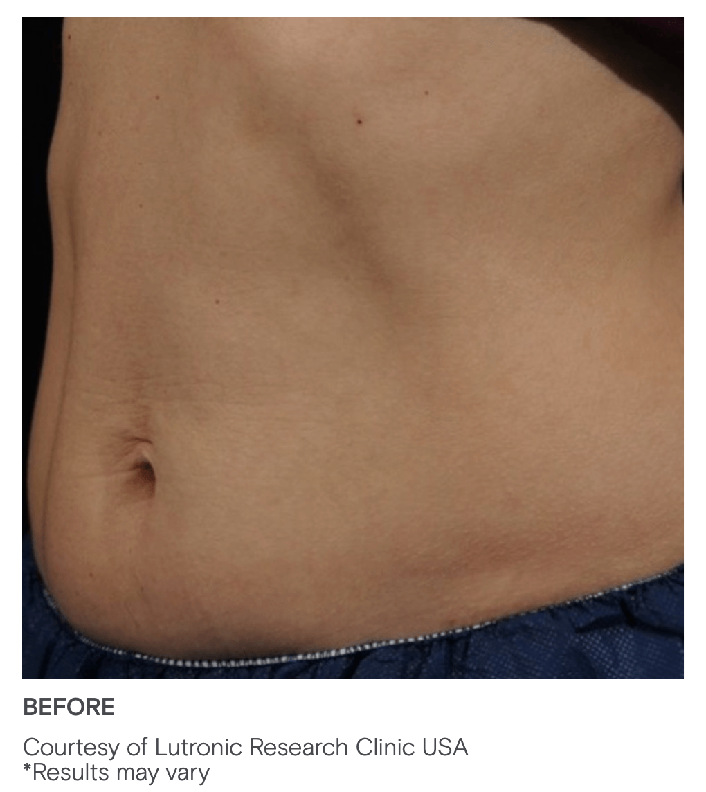 Accufit Before