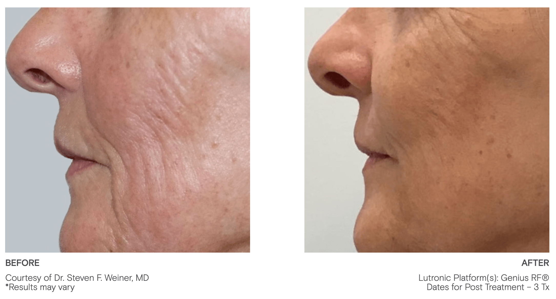 Skin Rejuvenation in New England Thiesen MD